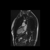 IRM cardiaque