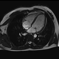 IRM Cardiaque 2