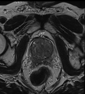Irm prostatique