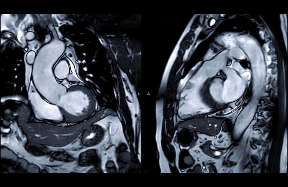 IRM cardiaque